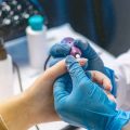 Combining Microneedling With Other Non-Surgical Treatments in British Aesthetic Clinics
