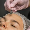 The Evolution of Non-Surgical Skin Treatments in the UK: Focus on Microneedling