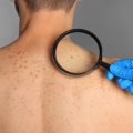 The Science Behind Laser Treatments for Vascular Lesions: How Does It Work?