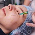Guidelines for Safe Laser Hair Removal in Diverse Skin Types in the UK