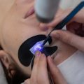 Navigating the Cost of Laser Skin Resurfacing in the UK: Factors, Insurance, and Value for Money