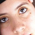 Pigmentation, Sun Spots, and Melasma: British Dermatological Solutions for Even Skin Tone