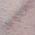 Navigating the Legal and Regulatory Aspects of Laser Hair Removal Clinics in the UK