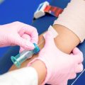 Tattoo Removal Aftercare: UK Clinic Protocol for Minimising Side-Effects