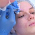 Peels, Micro-needling, and Other Minimally Invasive Skin Rejuvenation Options in Britain