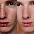 Gender Differences in Acne Presentation, Treatment, and Scarring in the UK Context