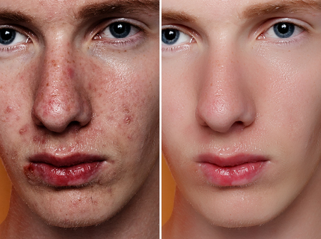 Gender Differences in Acne Presentation, Treatment, and Scarring in the UK Context