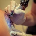 Real Stories: British Clients Share Their Laser Tattoo Removal Experiences