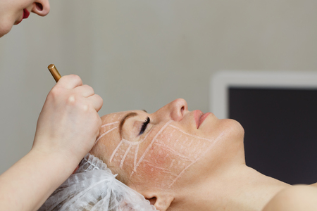 Chemical Peels and British Weather: How Climate Affects Results and Recovery
