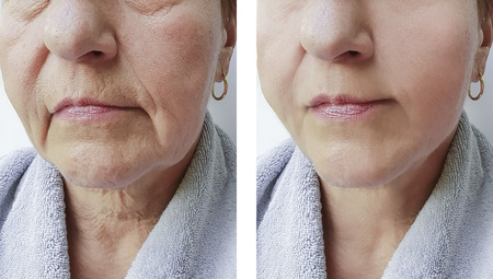The Role of Laser Skin Resurfacing in Anti-Ageing: Eliminating Wrinkles and Fine Lines the British Way