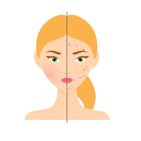 Navigating Sensitive Skin: Chemical Peels and the British Public