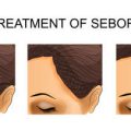 Addressing Keloid Scarring: Genetic Risk and Tailored Interventions for Ethnic Minorities in Britain