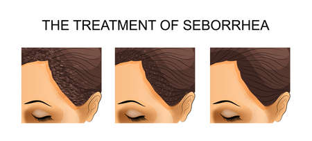 Addressing Keloid Scarring: Genetic Risk and Tailored Interventions for Ethnic Minorities in Britain