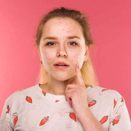 Rosacea Awareness and Advocacy in the UK: Resources and Support Networks