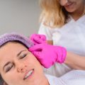 Microneedling for Hair Loss: Evidence and Experiences from British Clinics