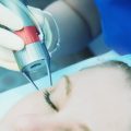 Microneedling Innovations: Latest Trends and Technology in the UK Market